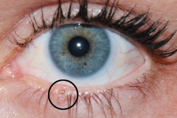 سرطان شبكية العين.. مرض خبيث وهذه أعراضه