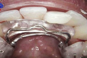 جهاز جديد نسبياً يعمل على تقويم الأسنان بسرعة فائقة