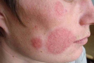 علماء ينشرون قائمة بأخطر أمراض الجلد
