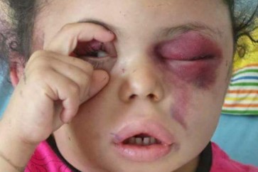الطفلة اليمنية المصابة بثينة